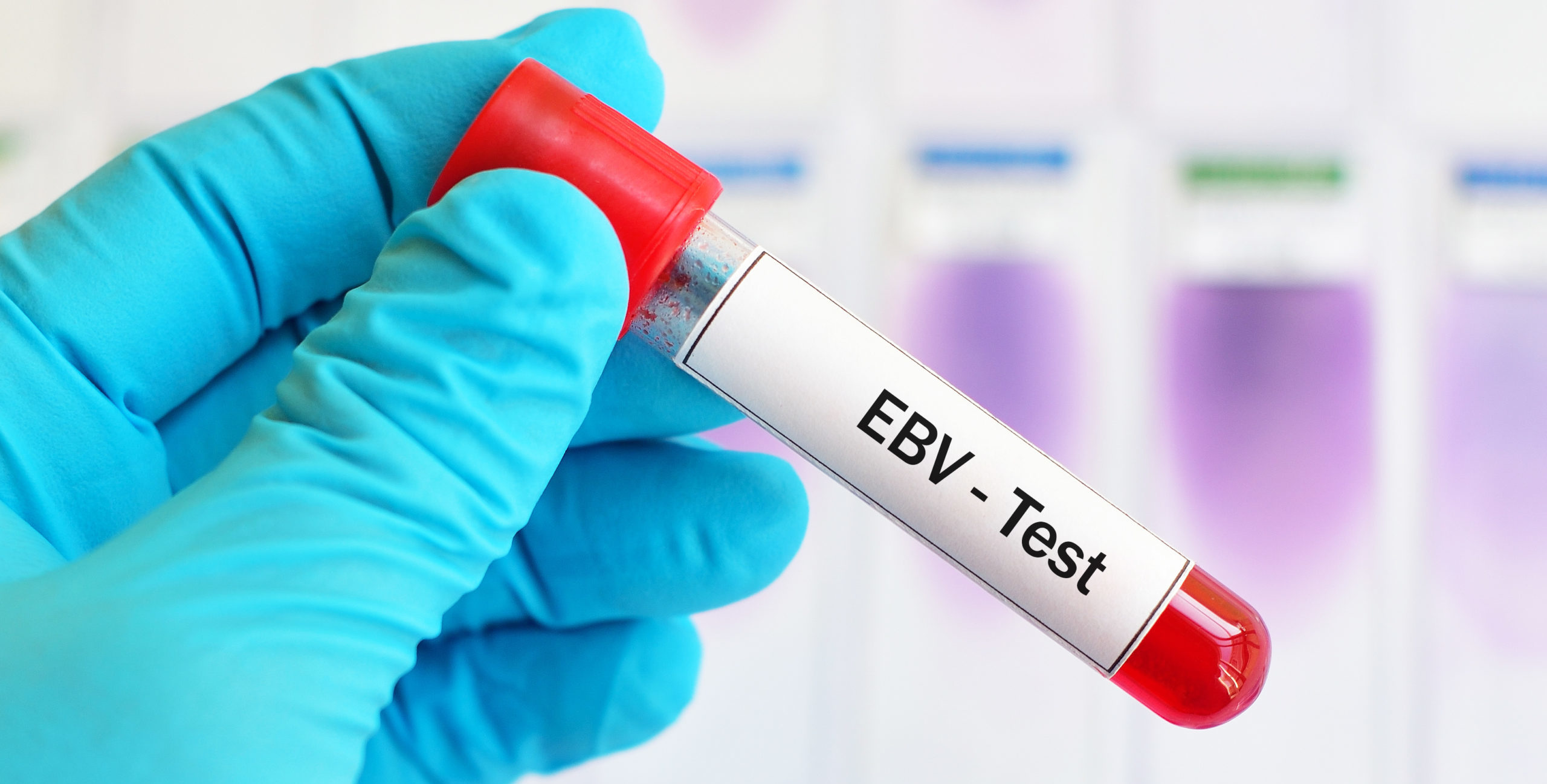 Masterclass online – Infecciones por el virus de Epstein-Barr (VEB) (3  partes) – AEMI
