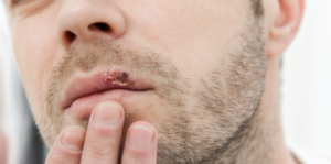 Webinar farmacias | Gestión de patologías de verano con microinmunoterapia: herpes, infecciones de orina, verrugas plantares, otitis y lesiones deportivas @ Madrid | Comunidad de Madrid | España